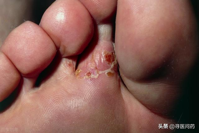 女性注意：私處老是瘙癢，或是感染了腳氣