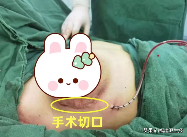 警惕！漳州16歲女孩一側(cè)乳房像吹氣球一樣瘋長！去醫(yī)院才發(fā)現(xiàn)……