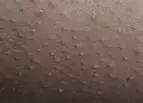 雞皮膚女生夏日自救！如何科學(xué)嫩膚提升精致度？