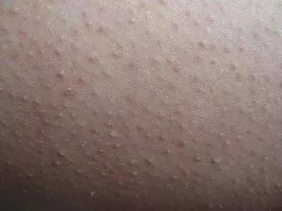 雞皮膚女生夏日自救！如何科學(xué)嫩膚提升精致度？
